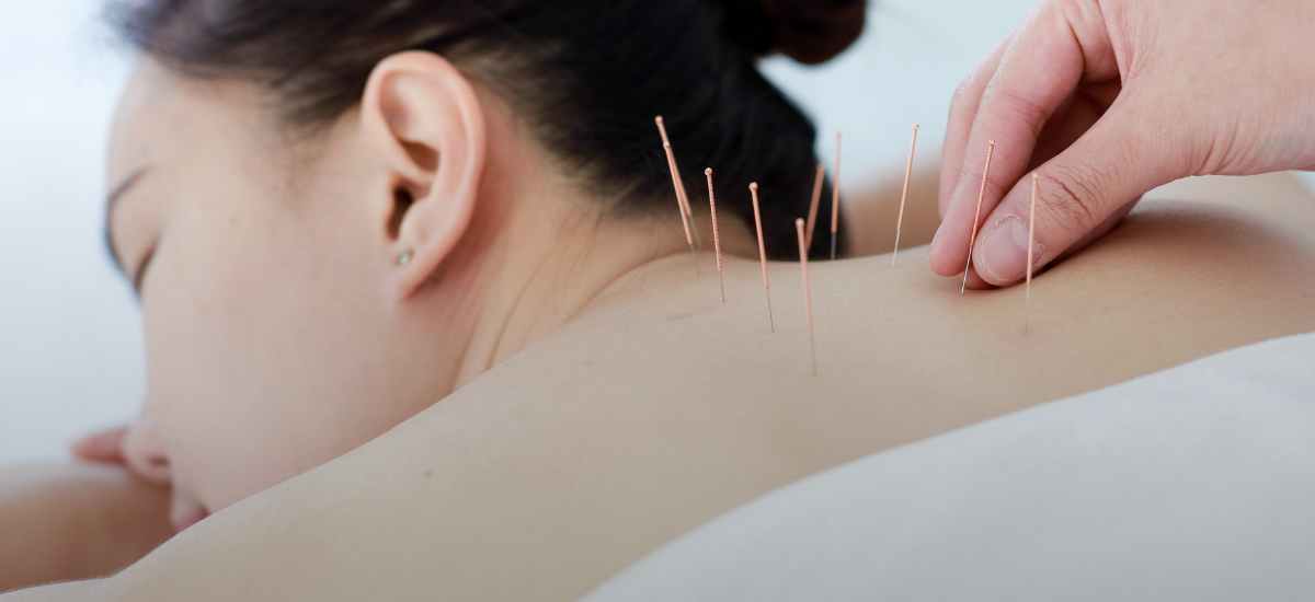 Relieving back pain with pins and needles