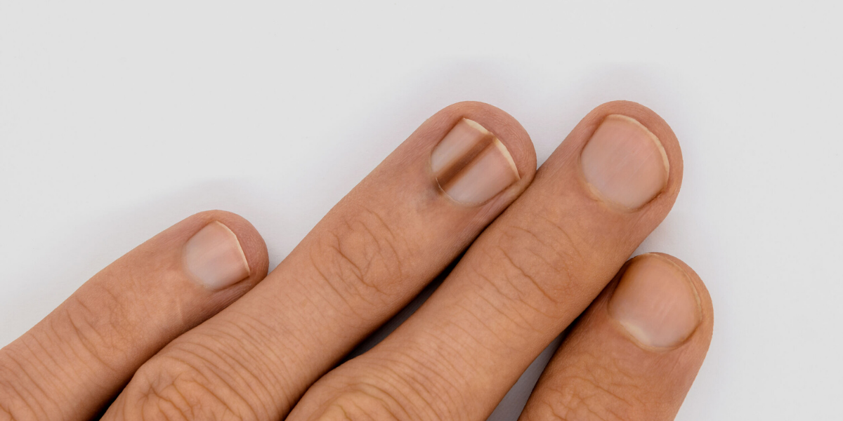 That Discolored Fingernail Could Be a Sign of Cancer  Moffitt