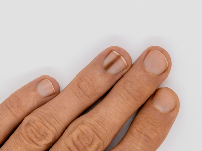 What is nail melanoma and is it a cause for concern?