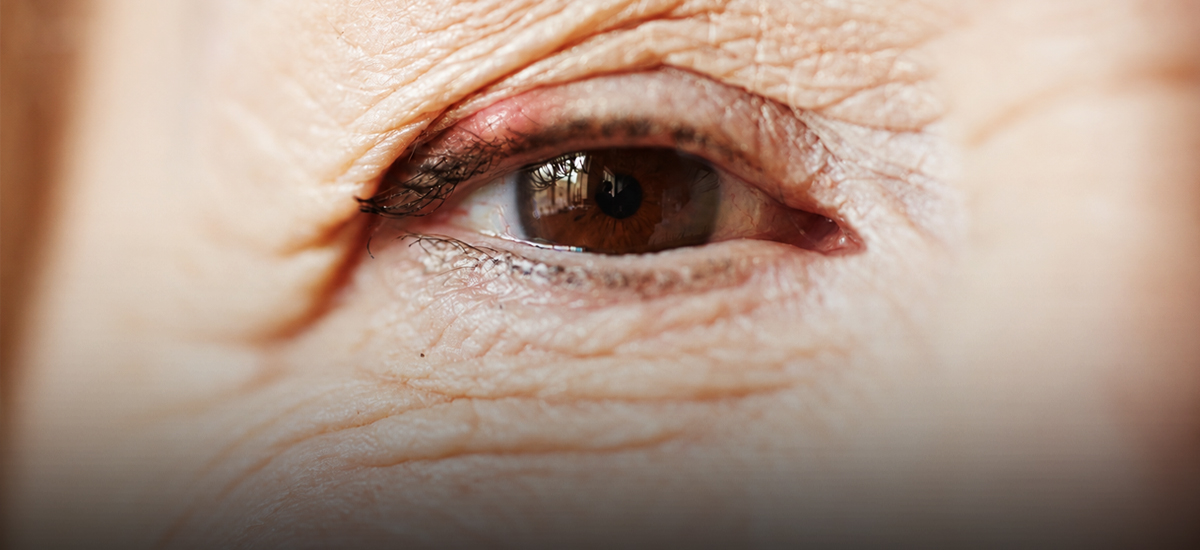 Keep getting styes? Could it be more than bad luck?