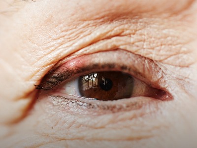 Keep getting styes? Could it be more than bad luck?