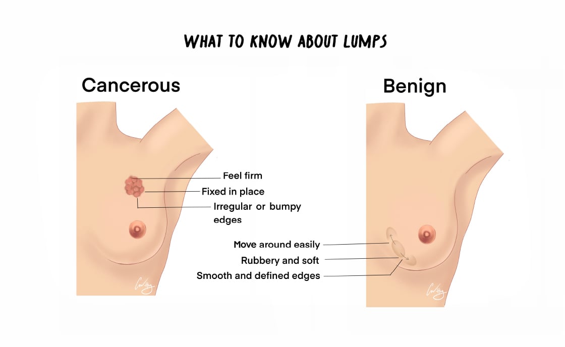 Check Your Breasts In 3 Simple Steps